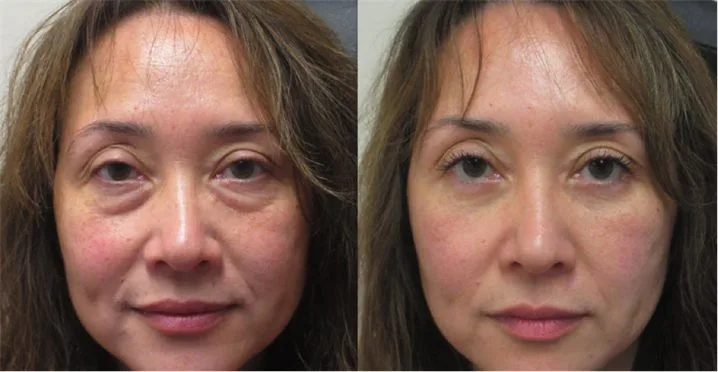 Linda M. — before and after